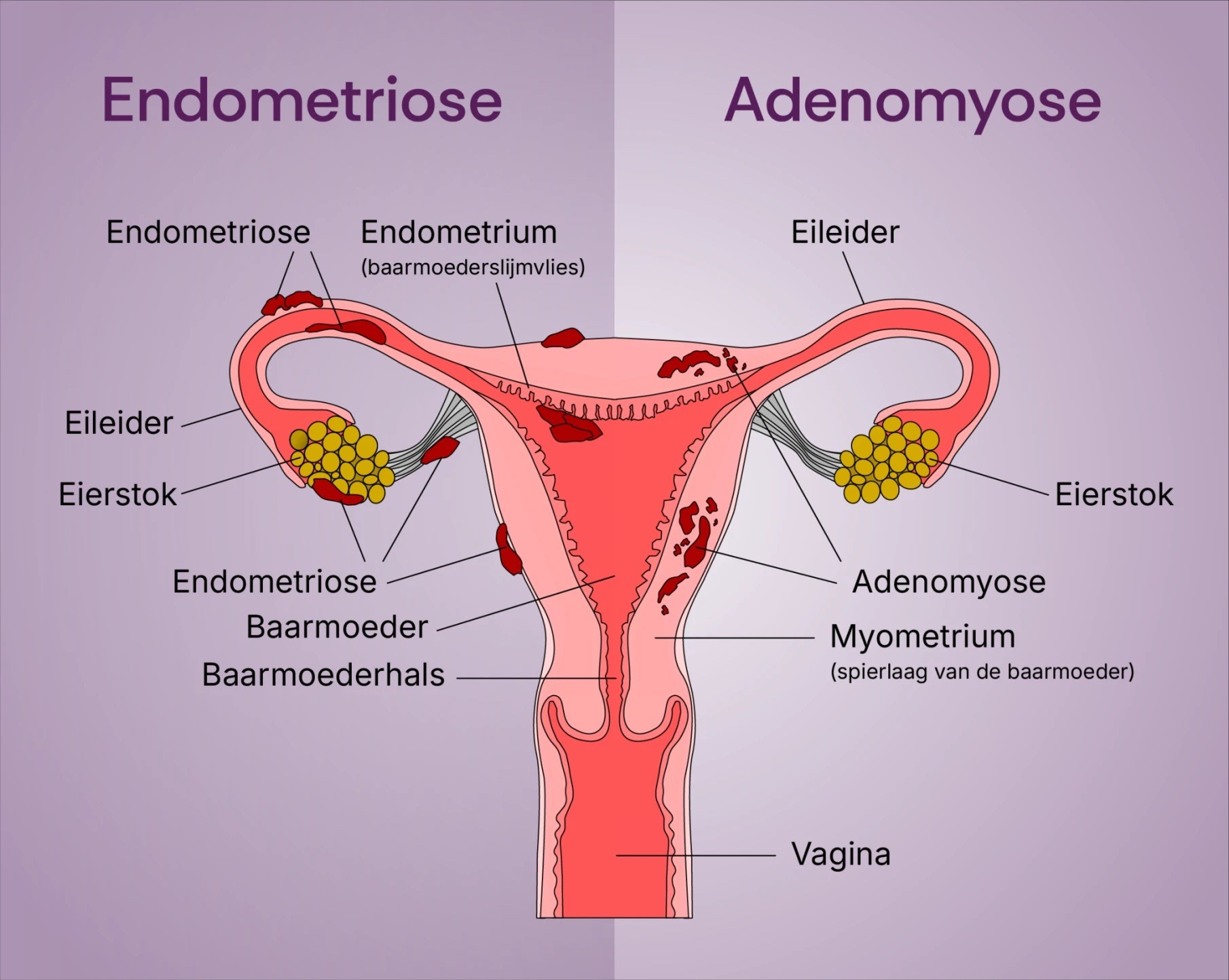 Wat is endometriose en hoe uit zich dat in de praktijk?